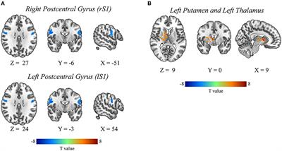 Dynamic and Static Amplitude of Low-Frequency Fluctuation Is a Potential Biomarker for Predicting Prognosis of Degenerative Cervical Myelopathy Patients: A Preliminary Resting-State fMRI Study